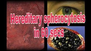 Hereditary Spherocytosis  A 60 sec Pathology lecture [upl. by Merchant]