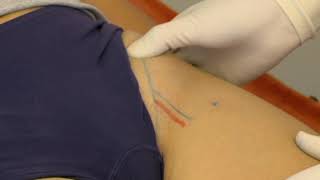 Injection for psoas bursitis [upl. by Evoy]