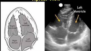 How to Cardiac Ultrasound  Apical View Case Study [upl. by Ashmead]