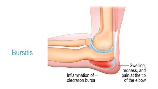 Treating Bursitis [upl. by Lazaruk100]