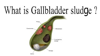 What is gallbladder sludge [upl. by Meingoldas]