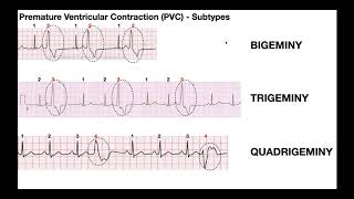 EKG Patterns  Premature Atrial amp Ventricular Contractions PACs amp PVCs [upl. by Ardnoik803]