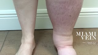 Got EDEMA 11 Medications that Cause Leg Swelling 2024 [upl. by Ennaer]