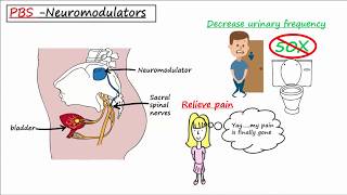 Painful Bladder Syndrome PBS  Interstitial Cystitis IC [upl. by Sehguh]