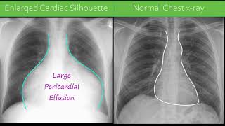 Chest xray  Pericardial Effusion [upl. by Rosalyn]