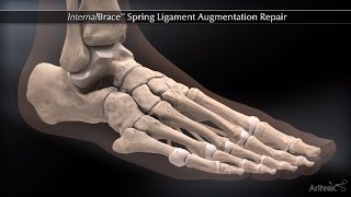 InternalBrace™ Spring Ligament Augmentation Repair [upl. by Juana]