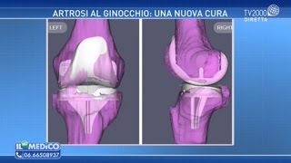 Artrosi al ginocchio una nuova cura [upl. by Ahsieyt]