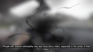 Symptoms and Causes of Diabetic Retinopathy with Irina Livshitz MD  Ohio State Medical Center [upl. by Janella]