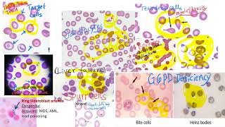 hematology in 10 min Peripheral blood smear examination under microscope [upl. by Hakim]