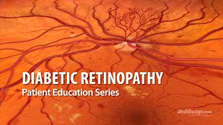 Hypertensive Retinopathy Fundoscopy [upl. by Katy741]