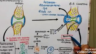 Rheumatic Fever  Part1  Causes  Pathogenesis  Sign amp Symptoms  AutoImmune Disease [upl. by Anabal3]