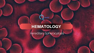 Hereditary Spherocytosis Hematology tutorials for NEETPG USMLE and MBBS [upl. by Ailiec935]