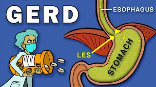 Gastroesophageal Reflux Disease GERD [upl. by Lenore]