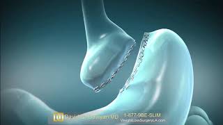 Gastric Bypass Bariatric Surgery Animation [upl. by Shivers]