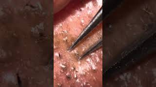 Ingrown hair plucking  tweezing ASMR [upl. by Glennis]