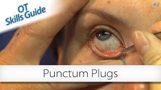 OT skills guide punctum plugs [upl. by Einaffit]