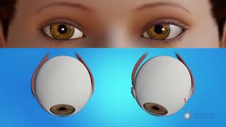 How is strabismus surgery done [upl. by Noryd855]