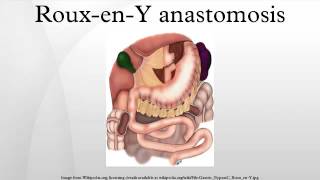 RouxenY anastomosis [upl. by Nicol437]