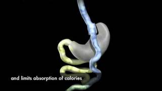 Laparoscopic RouxenY Gastric Bypass Surgery Animation [upl. by Gelhar]