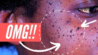 Why am I getting so many moles on my FACE Dermatosis Papulosa Nigra explained [upl. by Castra833]