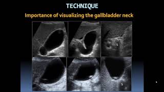 Basic Gallbladder [upl. by Aubree]