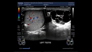 Ultrasound Video showing an Epididymal cyst [upl. by Nhguaval]