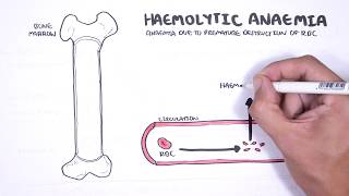 Haemolytic Anaemia  classification intravascular extravascular pathophysiology investigations [upl. by Anemaj]